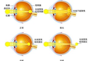 远视眼怎么矫正(远视眼怎么矫正手术)