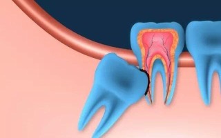 智齿拔不拔的危害(智齿抉择：拔或留的利弊权衡)