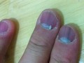 指甲里面发紫是灰指甲吗—指甲发紫揭示身体健康隐患