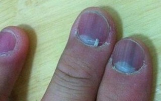指甲里面发紫是灰指甲吗—指甲发紫揭示身体健康隐患