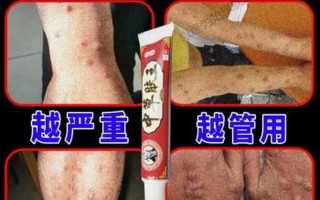 大腿胳膊痒—大腿胳膊痒用什么药