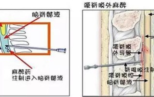 椎管进脂肪—椎管进脂肪：肥胖根源与治疗新方向