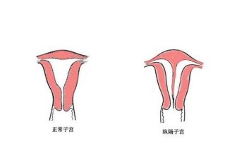 子宫先天性畸形(子宫先天性畸形图片)