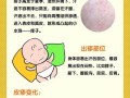 婴儿湿疹 热疹—婴儿湿疹热疹怎么分辨