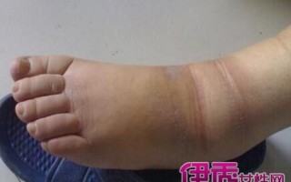 坐了一天小腿肿胀—小腿浮肿坐一天 赶走胀痛恢复轻盈