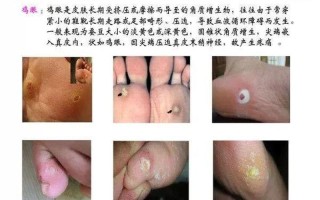 整个脚底板疼是什么原因引起的(脚底板周全剧痛，寻根探源解不适)