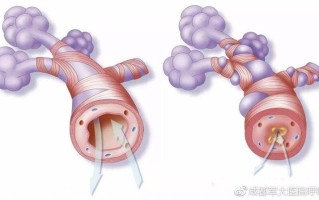 支气管炎的症状和肺炎的区别(支气管炎的警示信号：留意这些呼吸道症状)