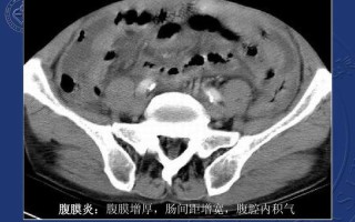 自发性腹膜炎_自发性腹膜炎：隐匿的腹腔杀手