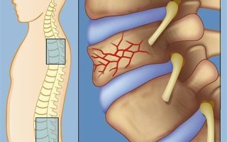 右侧腰骨疼是怎么回事(右侧腰骨痛：成因、症状及治疗方案探析)