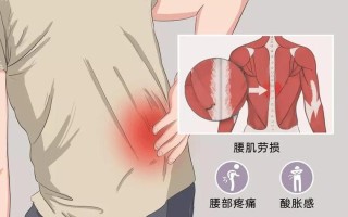 腰背左侧疼痛(左侧腰背疼痛：成因剖析及治疗对策)