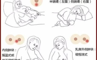 胀奶硬块怎么 *** —胀痛硬块：原因、症状与缓解 *** 