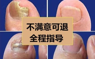 指甲与甲床分离(指甲与甲床脱离还能长出来吗)