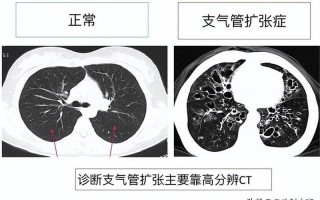 婴儿肺纹理增多—婴儿肺纹理增多能自愈