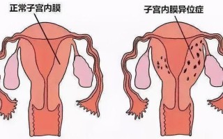 子宫内膜不均—子宫内膜不均：从病因到治疗策略