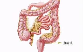 直肠ca严重吗(直肠癌发现一般是几期了)