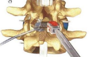 腰椎融合手术_脊柱稳定术：腰椎融合手术探秘