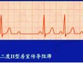 心电图有杂音(心电图有杂音能当兵吗)