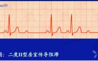 心电图有杂音(心电图有杂音能当兵吗)