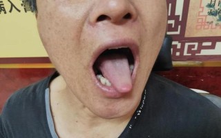 中年人鼻子出血(中年男子鼻血不止 疑似血压异常)