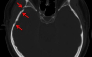 枕骨骨折严重吗_枕骨骨折的严重程度评估与治疗方案详解