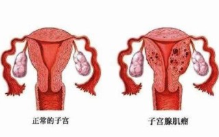 子宫肥大怎么治疗效果快啊图片—子宫肥大治疗指南：非手术和手术方式详解