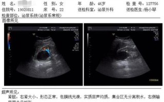 右肾无回声_右肾无回声暗区考虑囊肿是什么意思