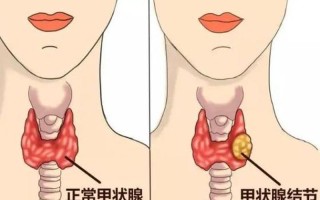 胸里疙疙瘩瘩(揭开胸膛里的谜：探索乳腺结节的秘密)