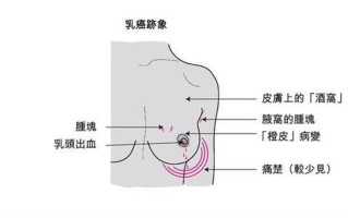 在下面疼是怎么回事_暗涌之痛：揭秘隐匿不宣的乳腺隐痛