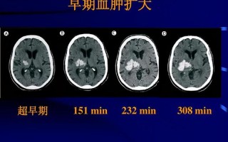 蛛网膜出血_蛛网膜出血恢复了好正常人一样吗