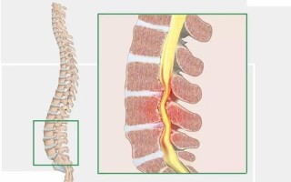 椎间盘突出和椎管狭窄_脊椎隐患：椎间盘突出与椎管狭窄的困扰