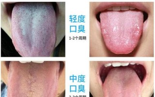 婴儿舌苔黄厚什么原因_新生儿舌苔黄厚：原因、治疗和预防指南