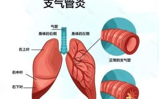 支气管炎如何治疗—支气管炎根治指南：症状、诊断和有效疗法