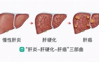 转氨酶44.2严重吗_转氨酶44.96：肝病隐形杀手，亟需关注