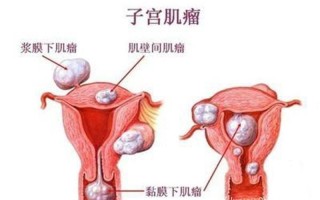 子宫肌瘤疼是不是已癌变_子宫肌瘤作痛的困扰：摆脱疼痛，重获健康