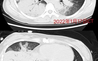 重症肺炎严重吗—重症肺炎：凶险不容小觑，尽早干预至关重要