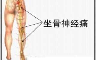 大腿的神经疼_大腿神经痛：隐痛刺痛，难以忍受