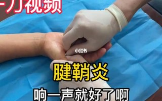 怎么治疗腱鞘炎_怎么治疗腱鞘炎更好