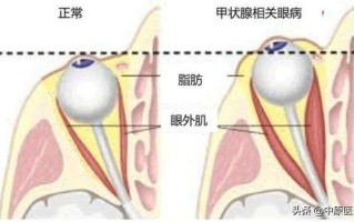 甲亢眼睛很不舒服(甲状腺风暴中的灼热之眼：揭开甲亢性眼病的秘密)