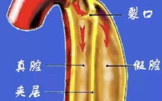 心脏主动脉(心脏主动脉夹层是什么病)