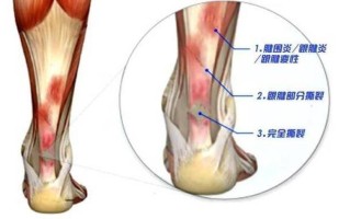 走路脚后跟很痛—走路脚后跟痛挂什么科