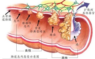 直肠多发息肉(直肠多发息肉是什么原因造成的)