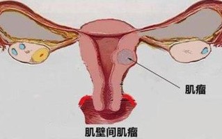 子宫粘膜下肌瘤是什么原因引起的(揭秘子宫粘膜下肌瘤——隐匿的女性健康杀手”)