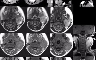增强ct怎么做—颈部增强ct怎么做