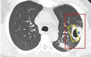 左肺空腔样病变—左肺门空腔影：影像学表现、鉴别诊断与临床意义