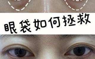 婴儿眼框发青—新生儿眼圈发青的新视角：揭开隐匿的健康奥秘