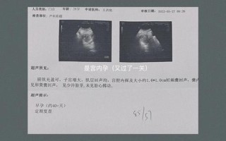 孕31周有一点点血丝—孕31周突现血丝，孕妈警惕先兆流产征兆