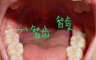 智齿挂什么科_智齿疼痛找哪科 一口解决疑难杂症