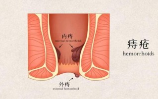 在家痔疮犯了怎么办_痔上眉梢，挥之不去的回家噩梦